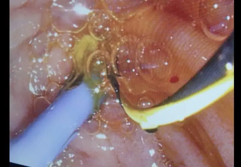 EndoGI medical S-Path short wire biliary plastic stent delivery system