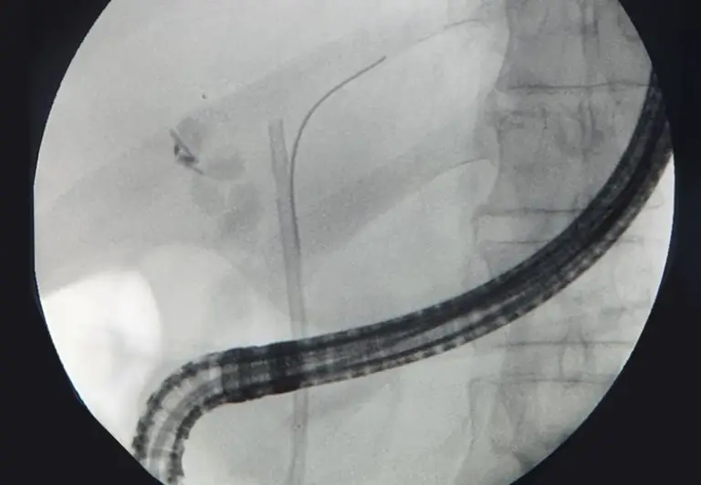 EndoGI medical S-Path short wire biliary plastic stent delivery system