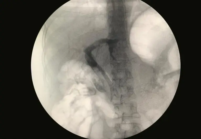 EndoGI medical S-Path short wire biliary plastic stent delivery system