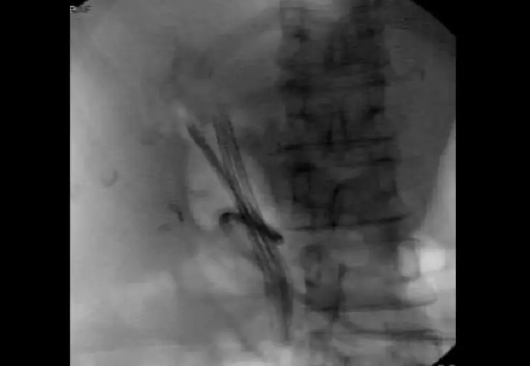 EndoGI medical S-Path short wire biliary plastic stent delivery system