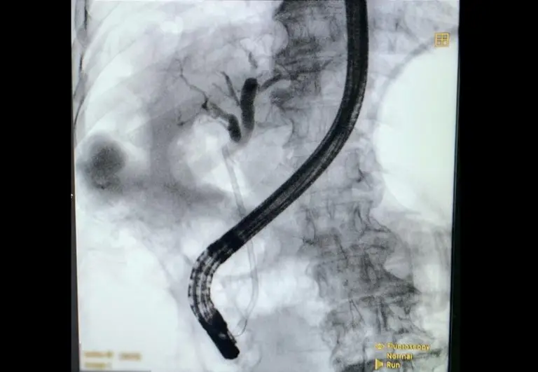 EndoGI medical S-Path short wire biliary plastic stent delivery system