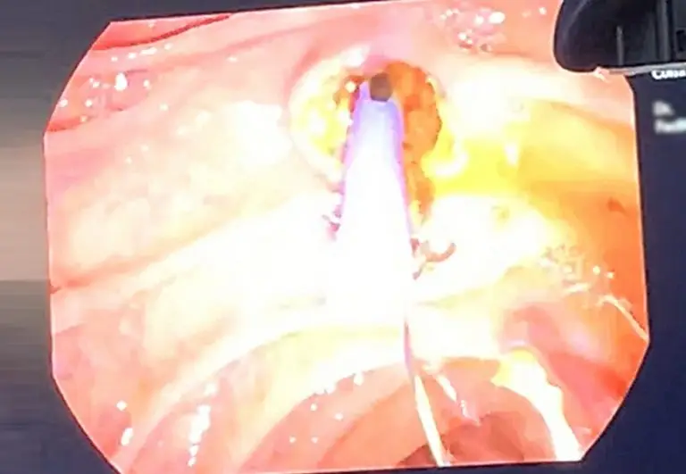 EndoGI medical S-Path short wire biliary plastic stent delivery system