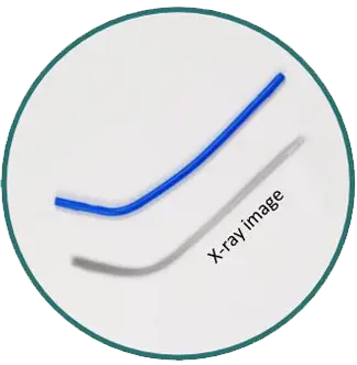 S-PATH STENT