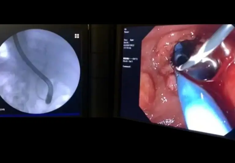EndoGI medical-S-Path short wire biliary plastic stent delivery system