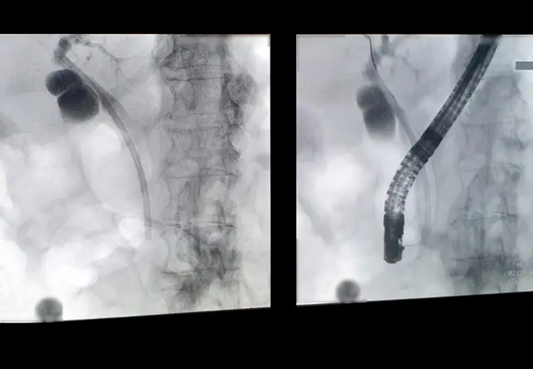 EndoGI medical S-Path short wire biliary plastic stent delivery system