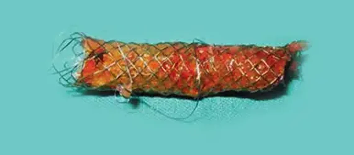 endo gi medical center Biliary stenting